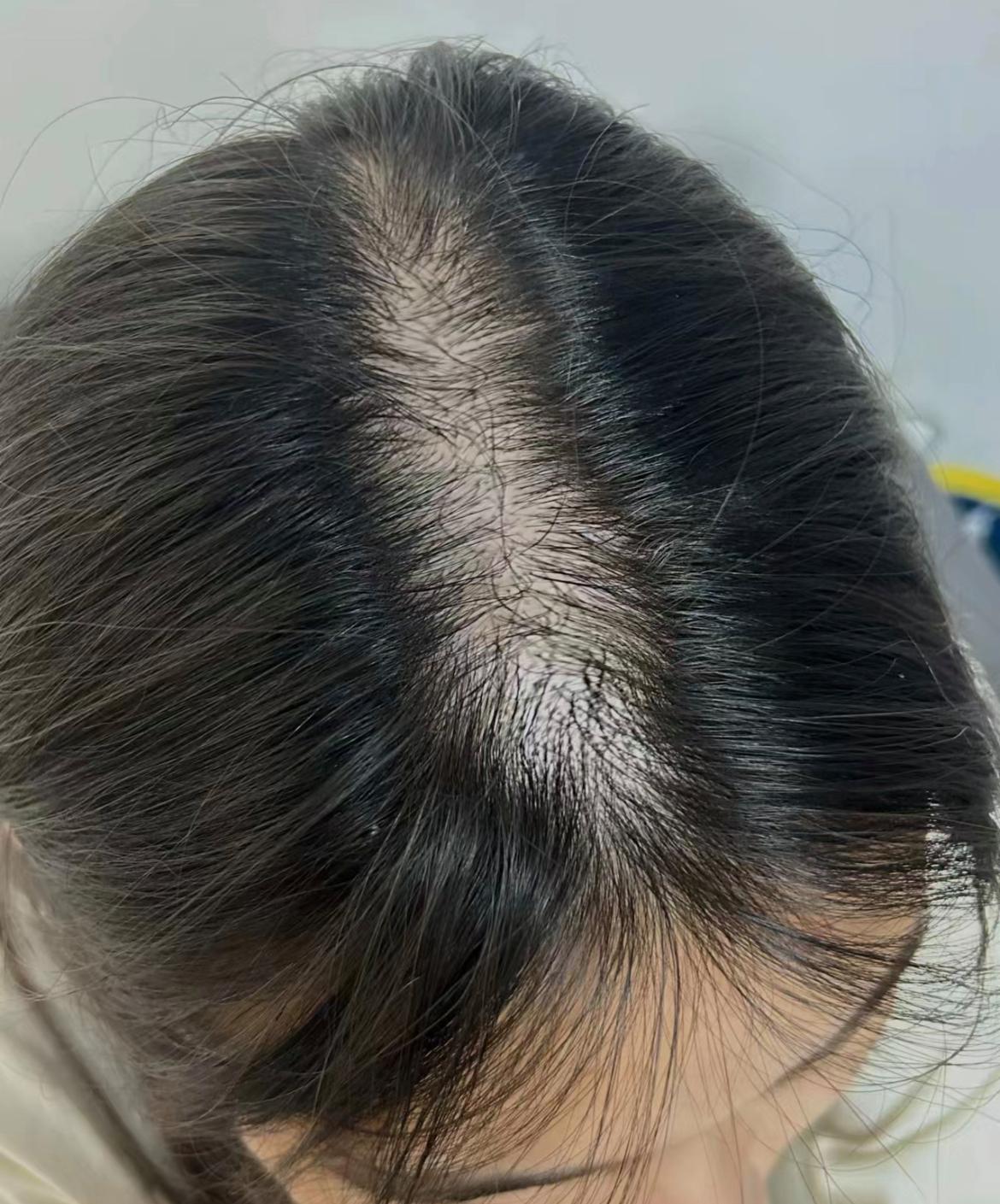 女生脱发、发际线后移严重，大部分是这几个原因，看你犯错了吗 onerror=