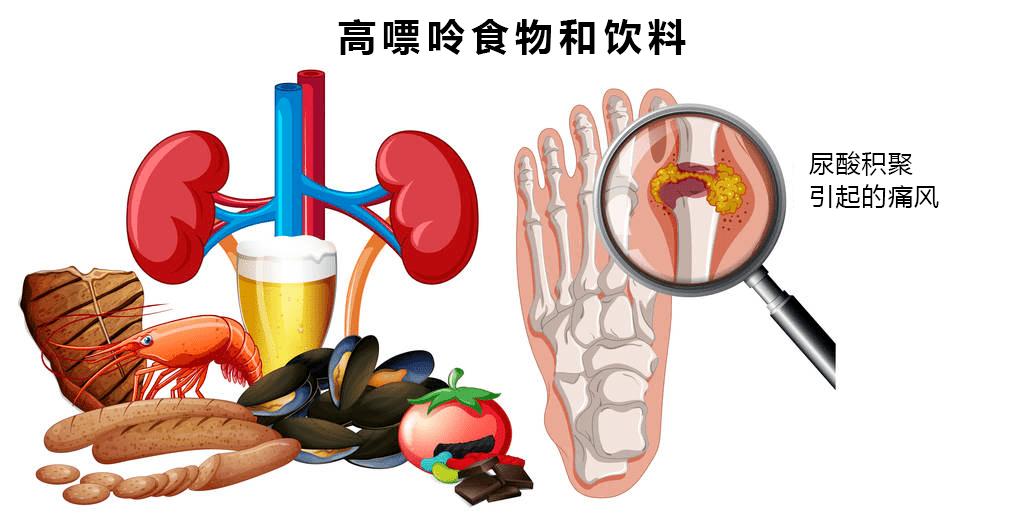 高尿酸警告：这两个低嘌呤的“痛风刺客” 一定要警惕！ onerror=