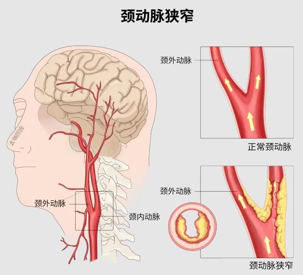 有颈动脉斑块就用阿司匹林？错！ onerror=