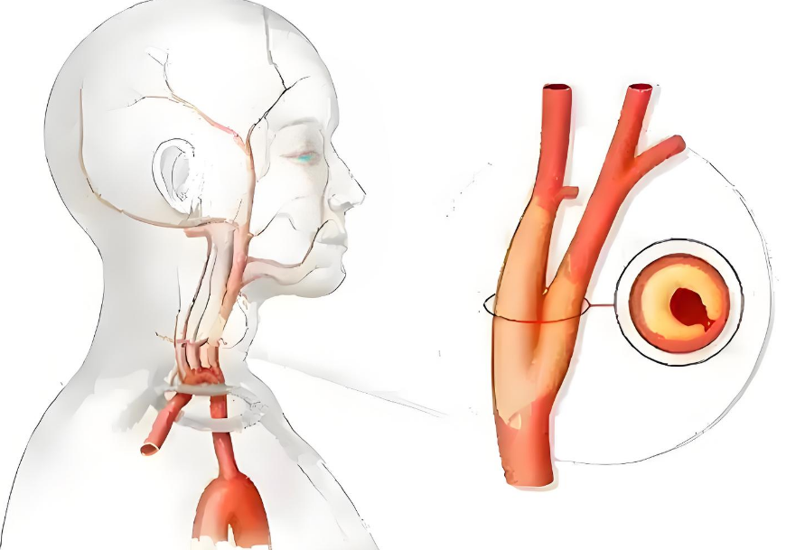近2亿人有颈动脉斑块！4.3万国人新研究：不用吃药，坚持做好这4点，颈动脉斑块风险降低36% onerror=