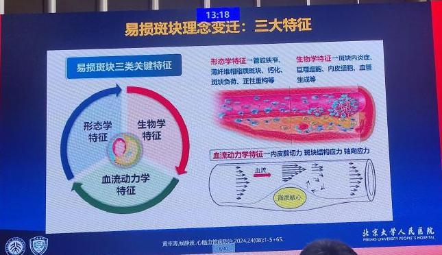 心梗的真凶！易损斑块的全程管理，看这篇就够了 onerror=